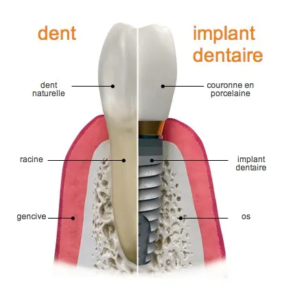 https://dentistefrancais.com/wp-content/uploads/2023/01/implantVSdent-FR.webp