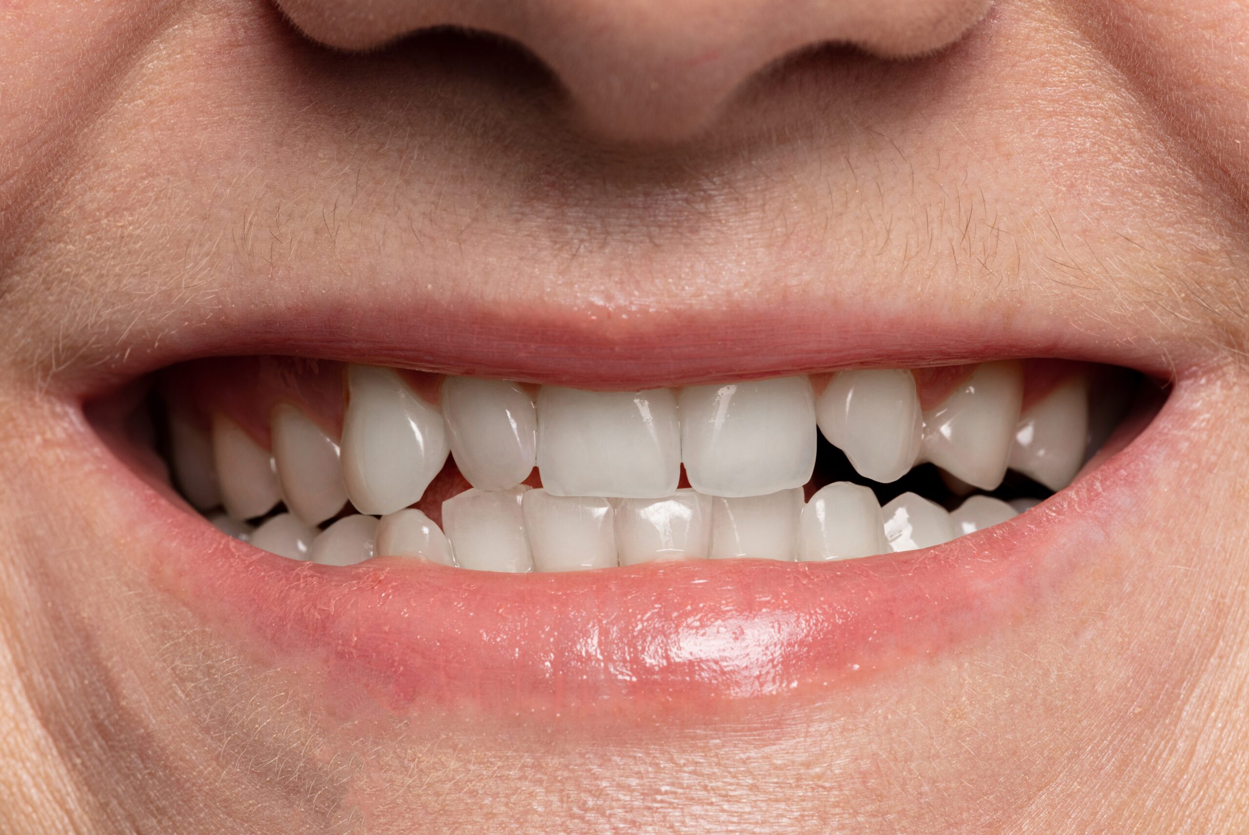 teeth whitening before and after close-up.